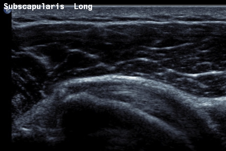 Shoulder Ultrasound Subscapularis Normal